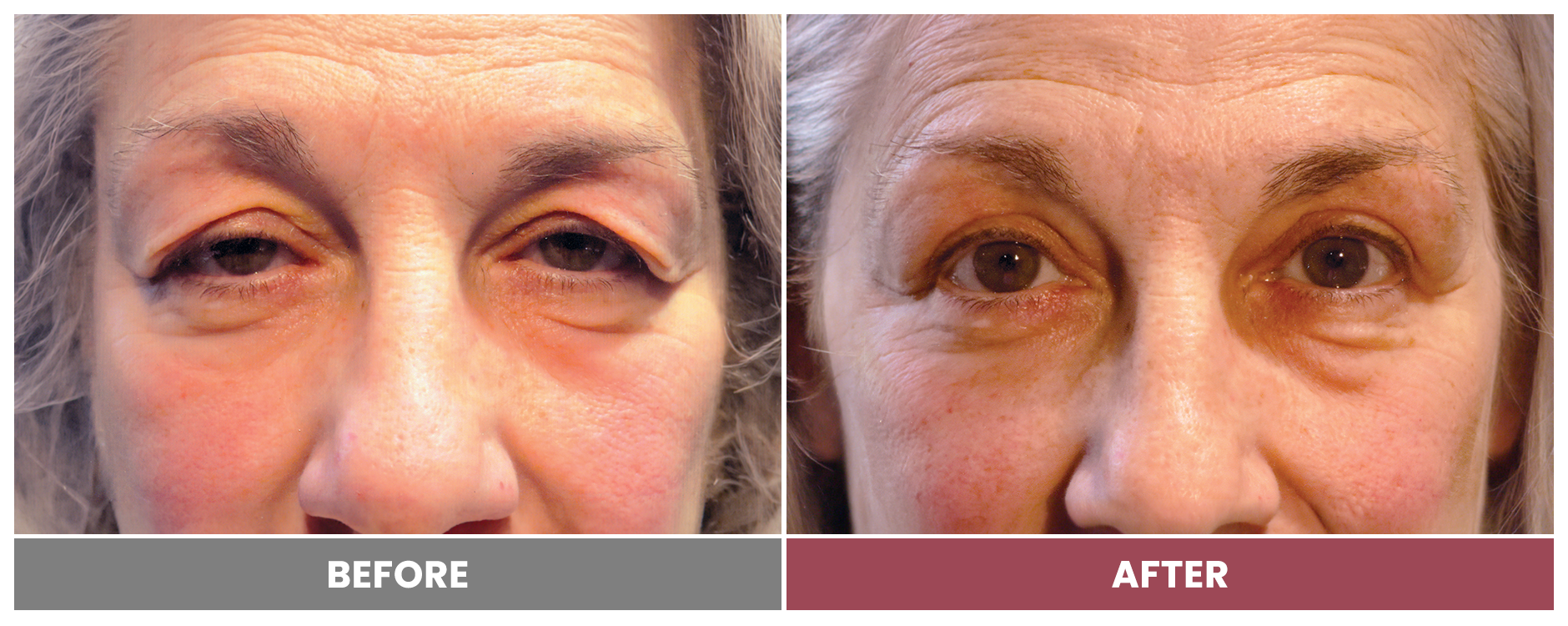 Upper Blepharoplasty - Case 28